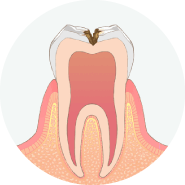 虫歯が神経に近くなり、冷たいものがしみます